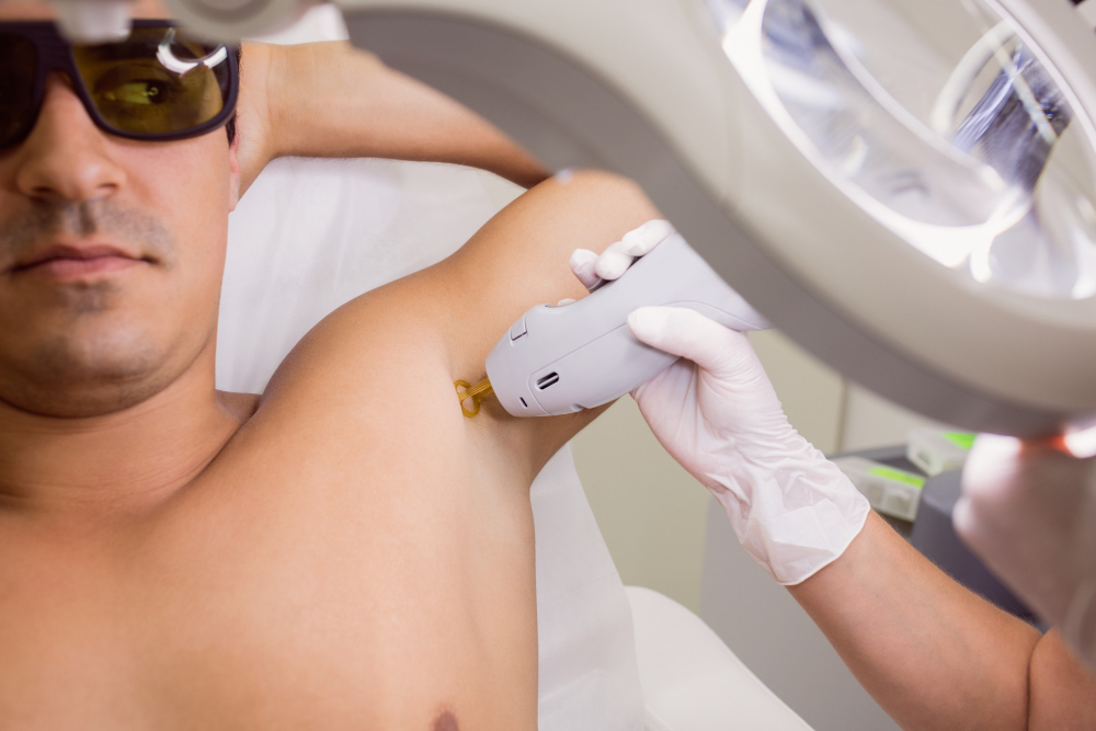 man laser hair removal